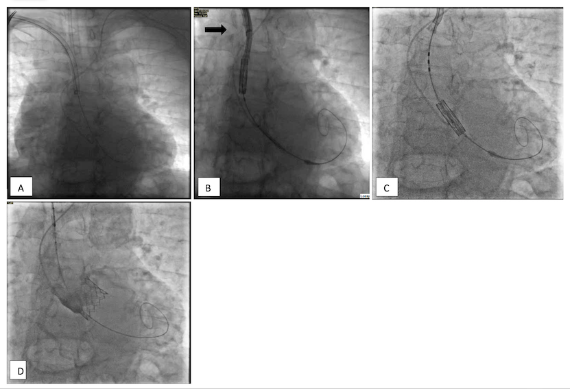 Adapations in Transaxillary Access for TAVI With Sapien Ultra Valve
